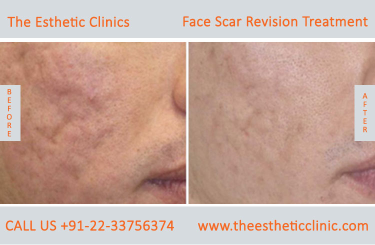 Facial Scars Revision laser Treatment for Face before after photos in mumbai india (5)